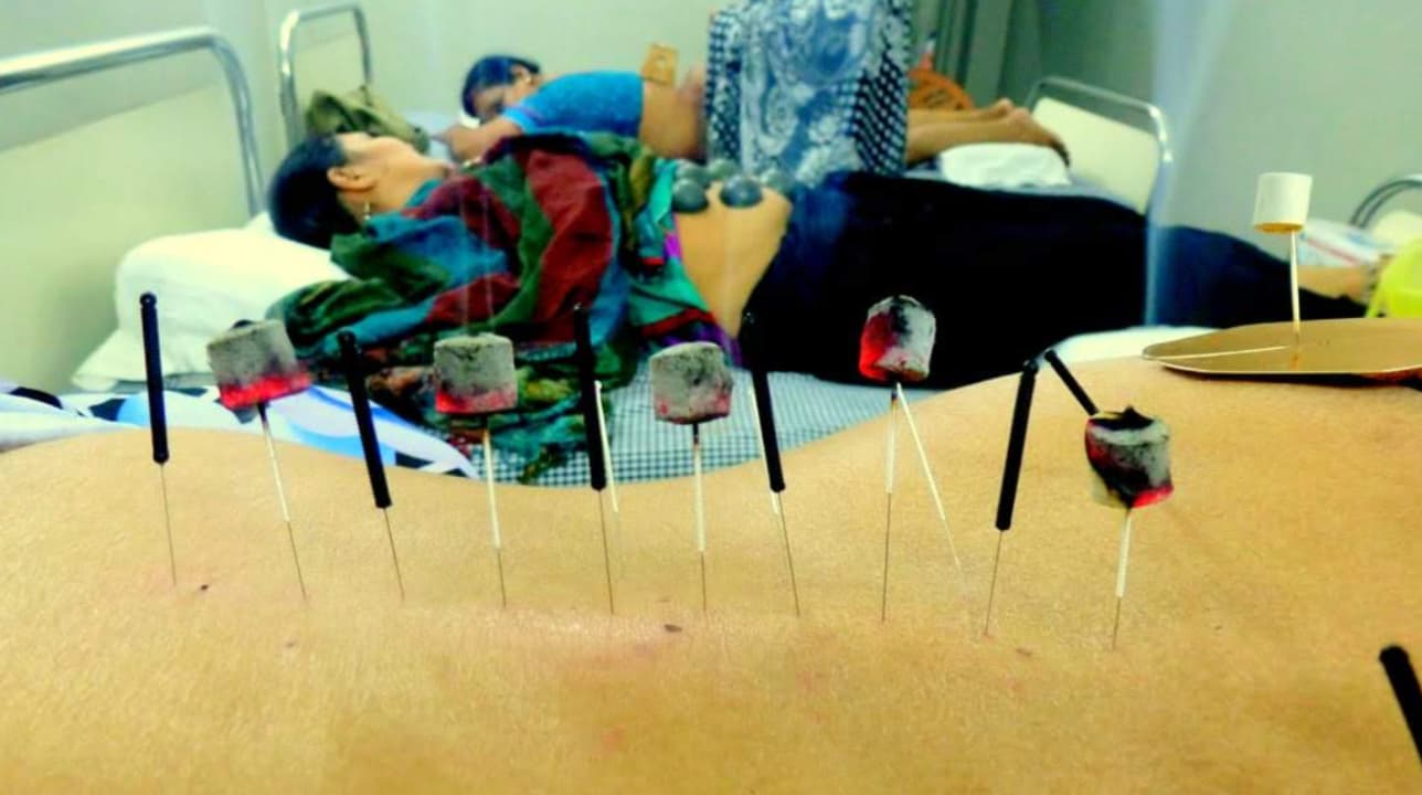 Acupuncture treatment at Acutouch Wellness Faridabad